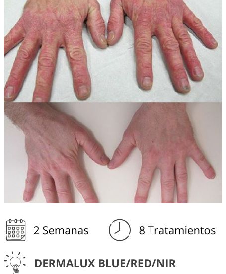psoriasis dermalux blue red nir