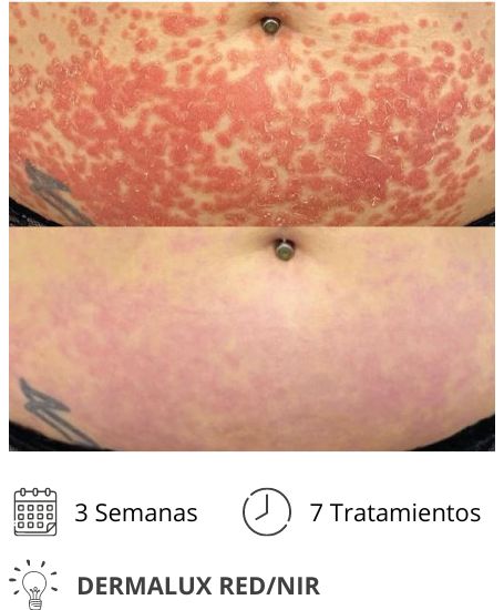 psoriasis dermalux red nir