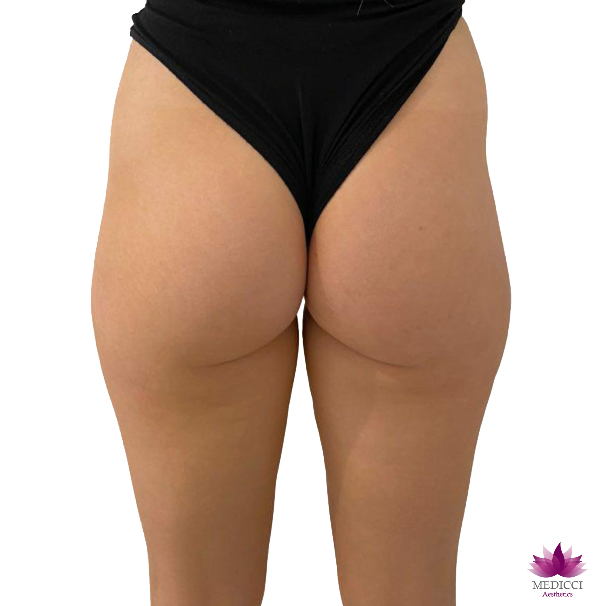 FOTO-ANTES-Genefill-Contour