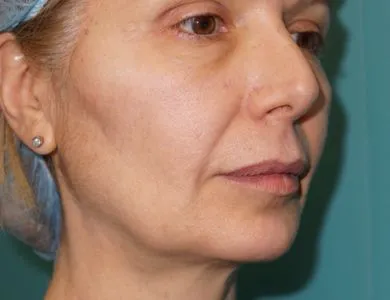 imgi_15_antes-yd-espues-sellaesthetic-hilos-aptos-2