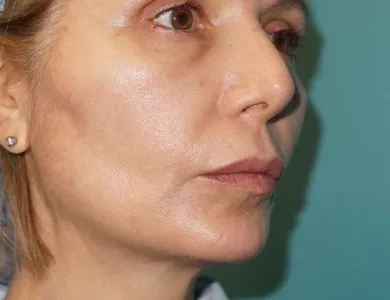 imgi_16_antes-yd-espues-sellaesthetic-hilos-aptos-1