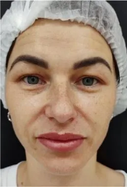 imgi_17_antes-sellaesthetic-cellbooster