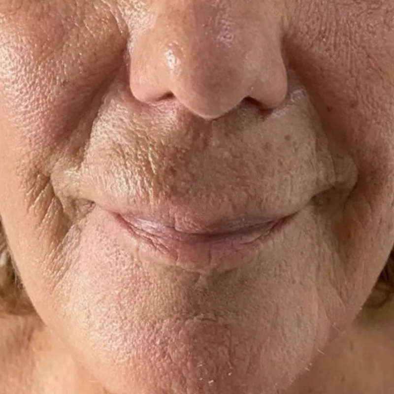 imgi_18_despues-del-colageno