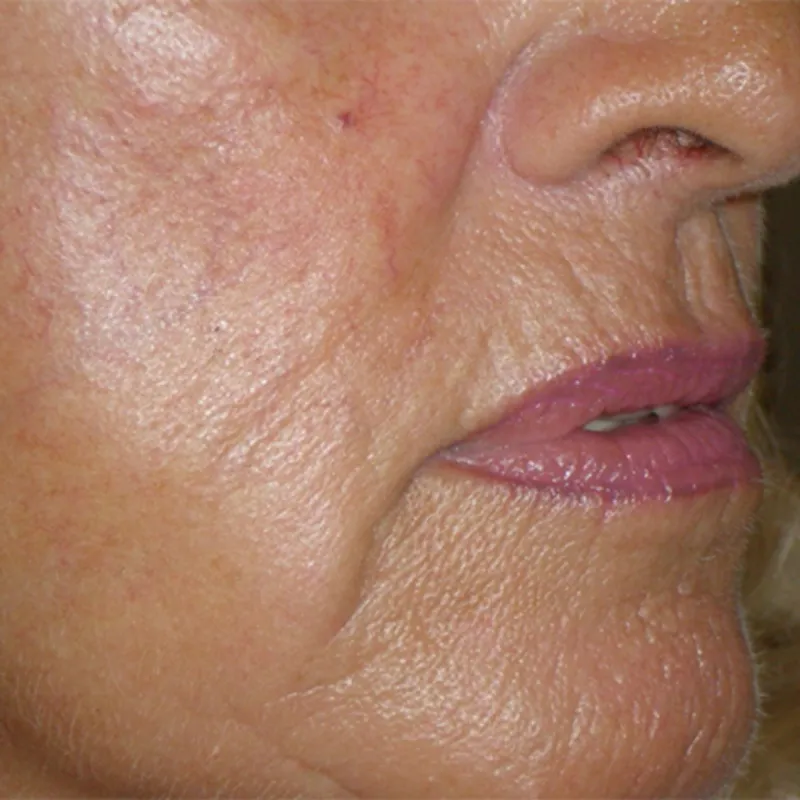 imgi_19_antes-del-colageno-karisma