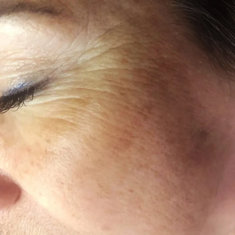 imgi_23_antes-arrugas-periorbitales