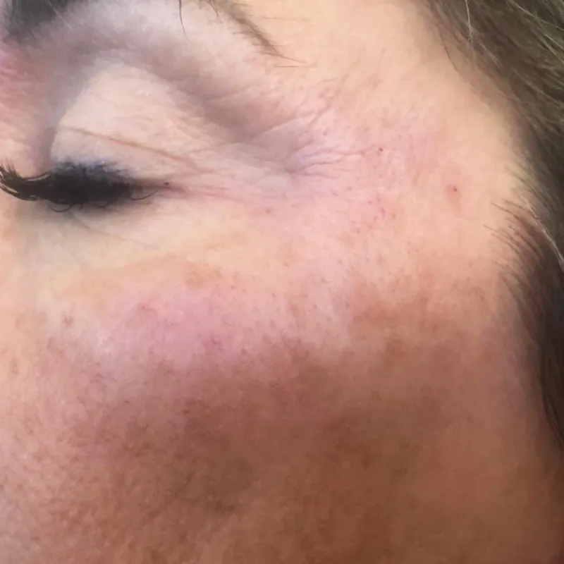 imgi_24_despues-arrugas-periorbitales