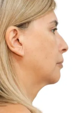 imgi_26_despues-cellbooster-shape