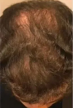 imgi_29_antes-cellbooster-hair