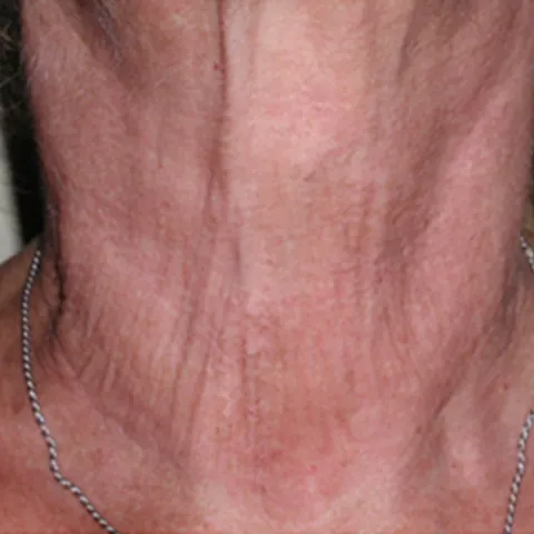 imgi_57_antes-bioreconstruccion-cuello-colageno-480x480
