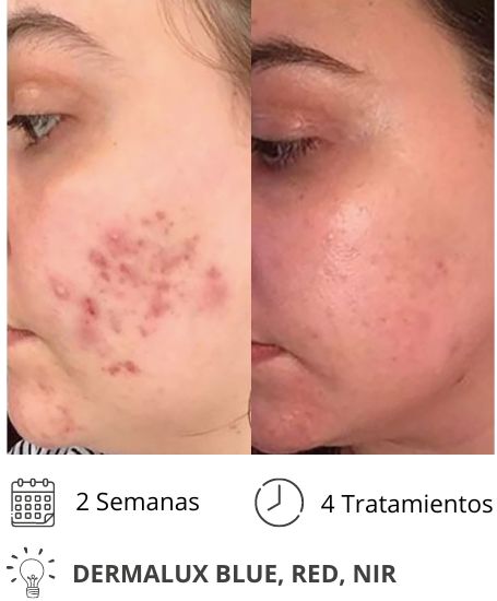 Dermalux MD Flex Fototerapia