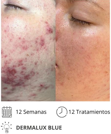 Dermalux MD Flex Fototerapia