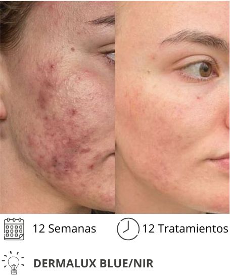 Dermalux MD Flex Fototerapia