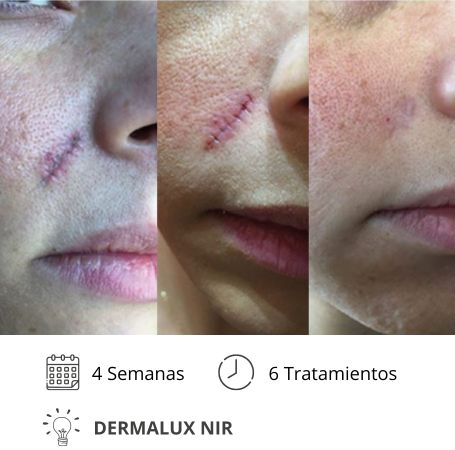 Dermalux MD Flex Fototerapia