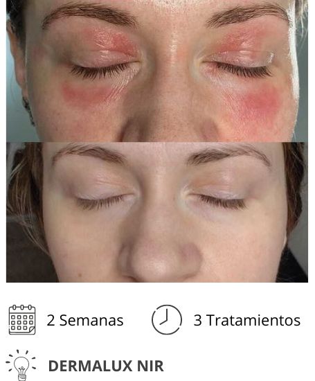 Dermalux MD Flex Fototerapia