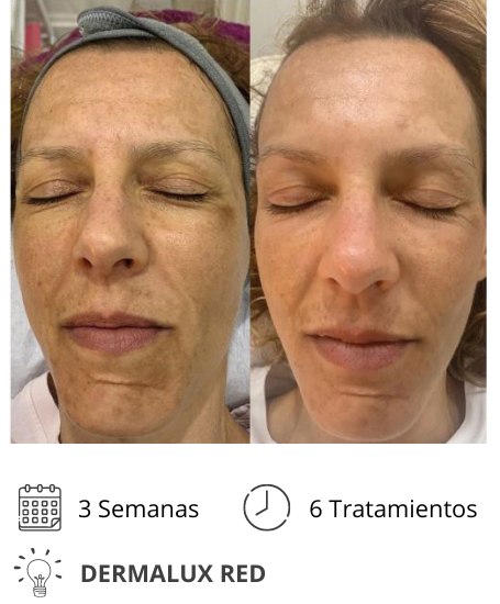 Dermalux MD Flex Fototerapia