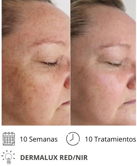 Dermalux MD Flex Fototerapia