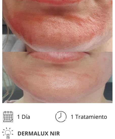 Dermalux MD Flex Fototerapia