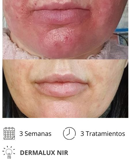 Dermalux MD Flex Fototerapia