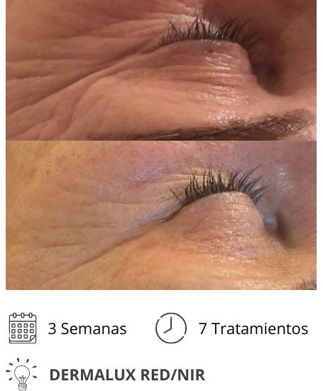 Dermalux MD Flex Fototerapia