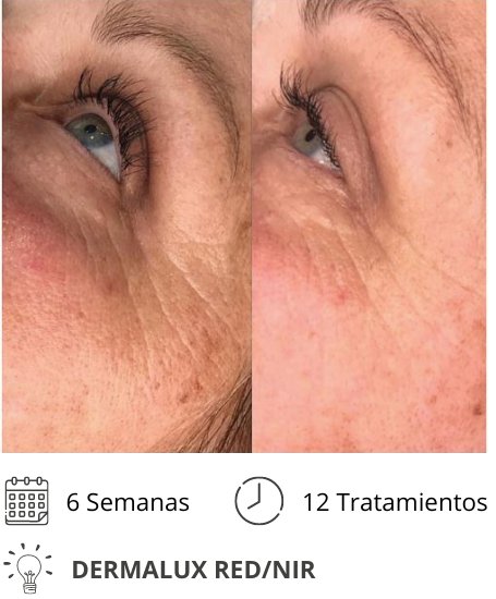 Dermalux MD Flex Fototerapia