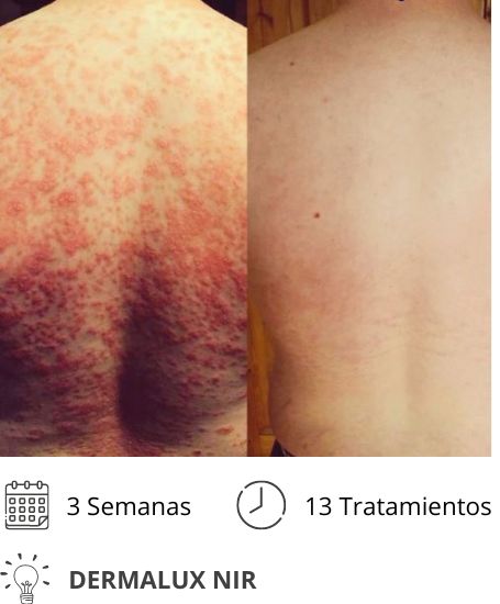 Dermalux MD Flex Fototerapia