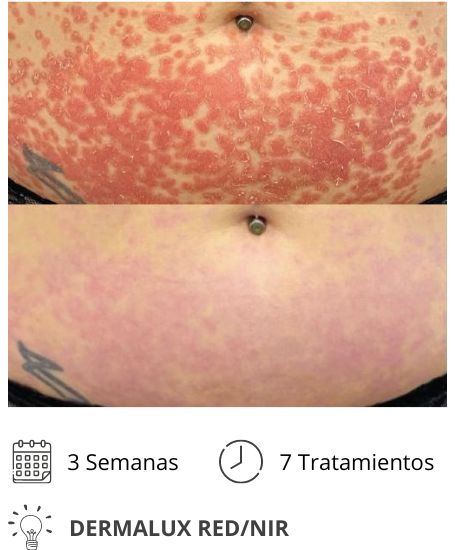 Dermalux MD Flex Fototerapia