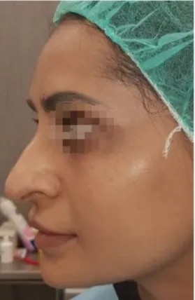 imgi_11_Antes-rinoplastia