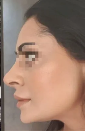 imgi_12_Despues-rinoplastia