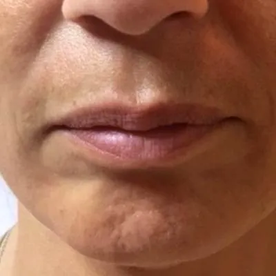 imgi_12_antes-apriline-normal