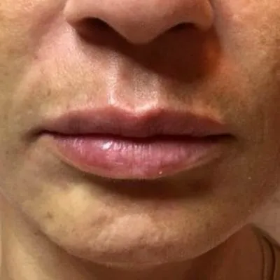 imgi_13_despues-apriline-normal