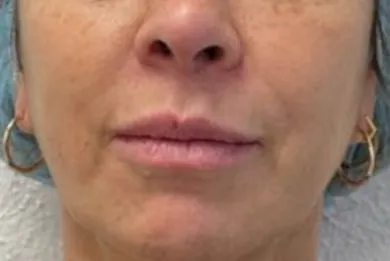 imgi_14_Antes-hilos-LLS