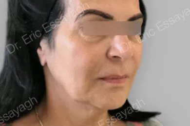 imgi_16_antes-hilos-aptos-evs-method