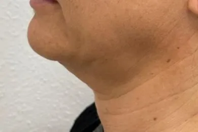 imgi_17_ANTES-BODY-WIRE-METHOD