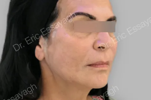 imgi_17_FOTO-DESPUES-EVS-METHOD