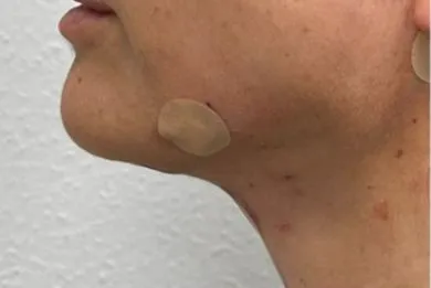 imgi_18_DESPUES-BODY-WIRE-METHOD