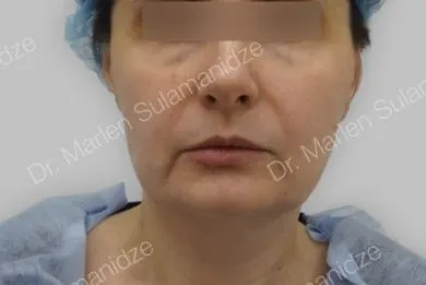 imgi_19_Antes-Light-Lift-Thread-Method