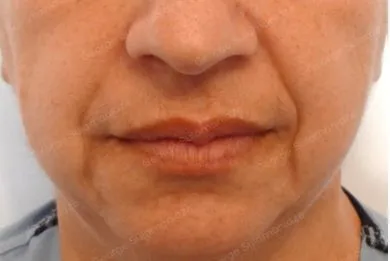 imgi_20_Antes-hilos-aptos-nano-vitis