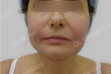 imgi_20_Despues-Light-Lift-Thread-Method