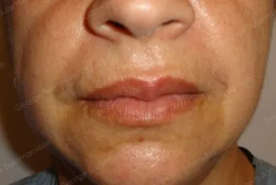 imgi_21_Despues-hilos-aptos-nano-vitis