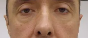 imgi_29_Despues-Correccion-de-las-orejas-300x132