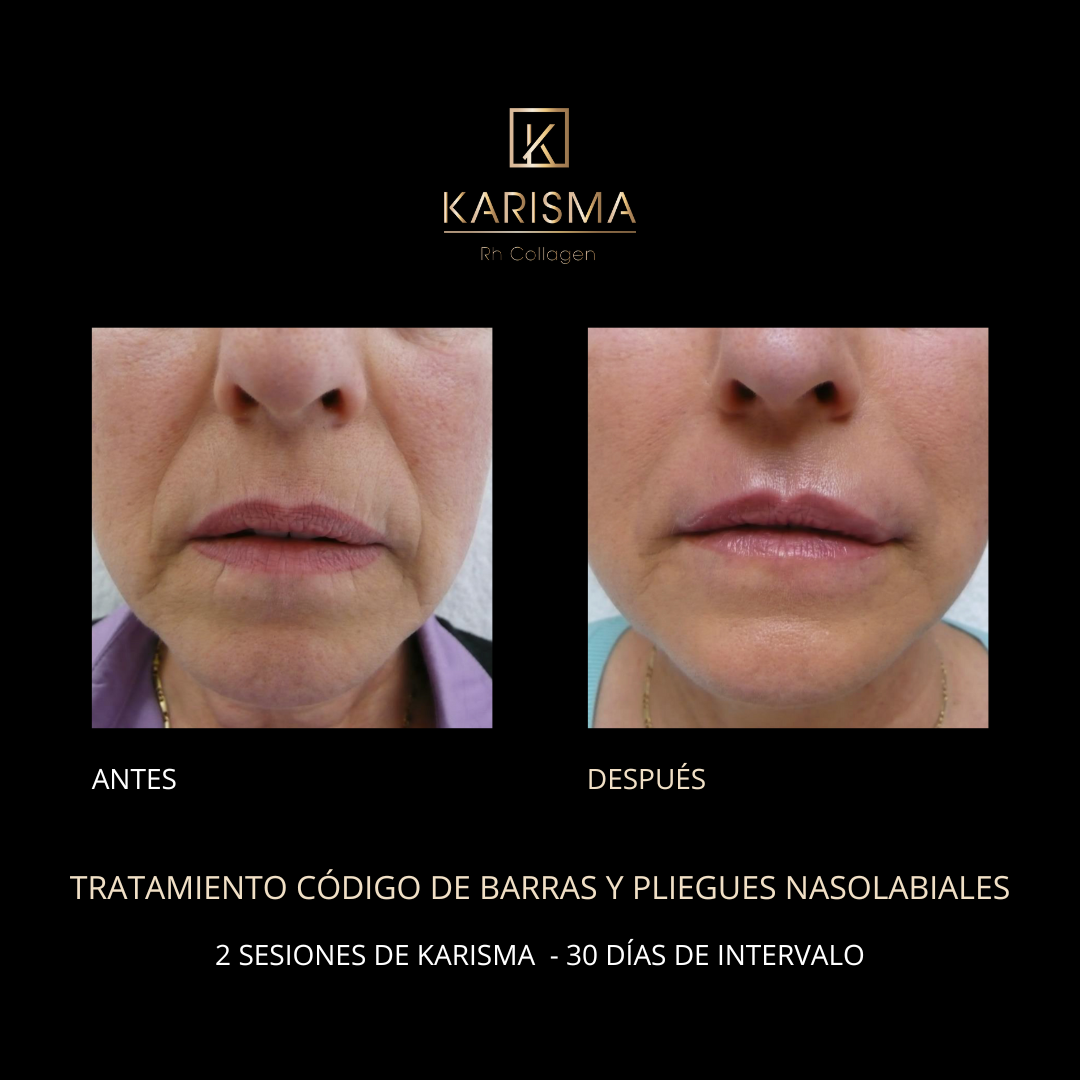 PLANTILLA BEFORE AND AFTER KARISMA