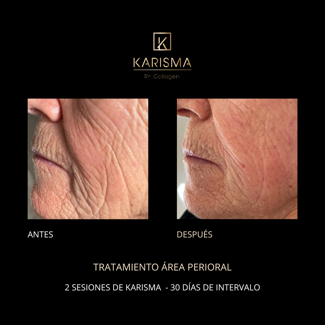 PLANTILLA BEFORE AND AFTER KARISMA